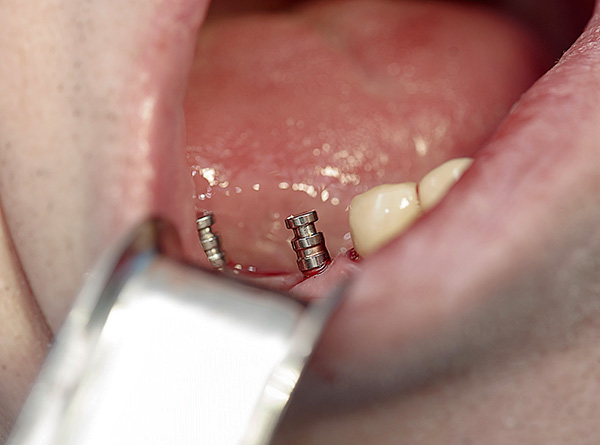 As próteses de fecho em implantes oferecem várias vantagens, mas o preço é muito mais caro do que outras opções para fixação da prótese.