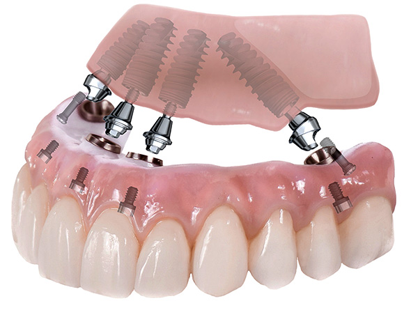 A imagem mostra o esquema das próteses dentárias usando a tecnologia All-on-4.