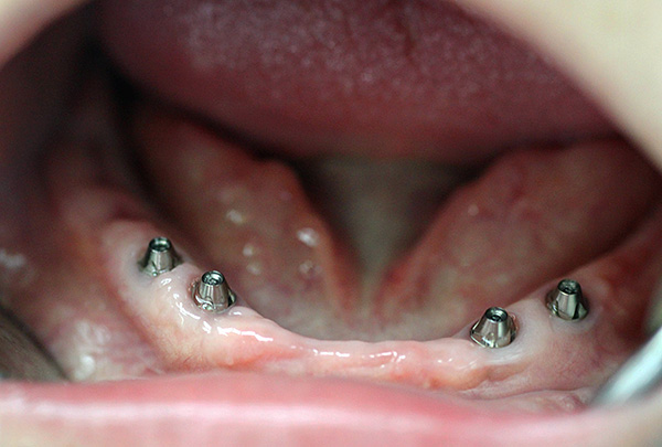 4 implantes são implantados na mandíbula ...
