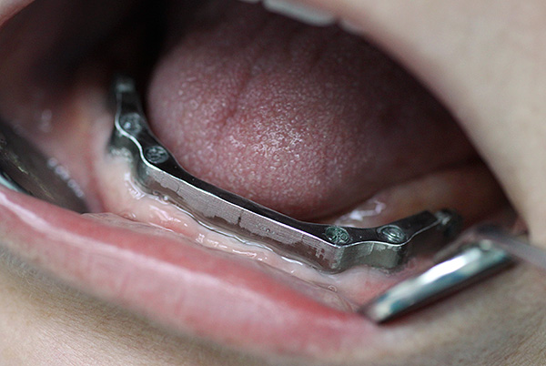 Uma viga de metal é anexada aos implantes.