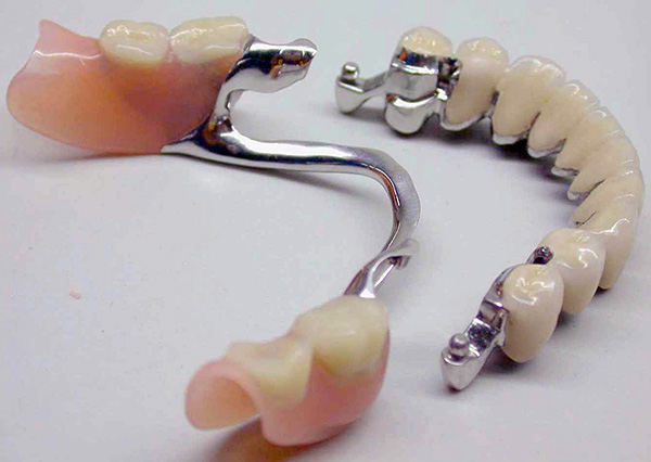 E é assim que a prótese de fecho com fixação em anexos (isto é, micro fechaduras) se parece.