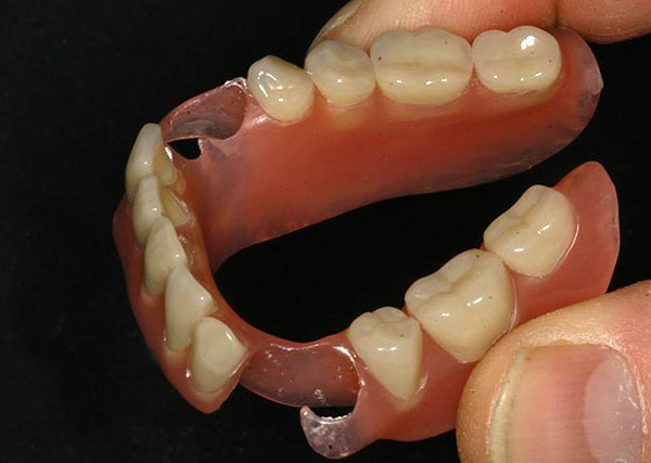 Com um grande número de dentes ausentes na boca, o uso de uma prótese de nylon estará longe de ser a melhor opção para próteses ...
