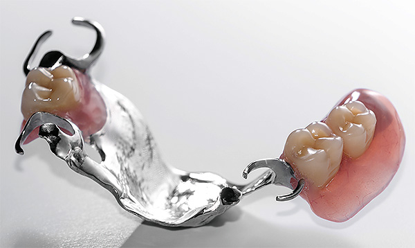 A opção mais simples para uma prótese removível é uma estrutura montada nos dentes com ganchos metálicos (grampos).