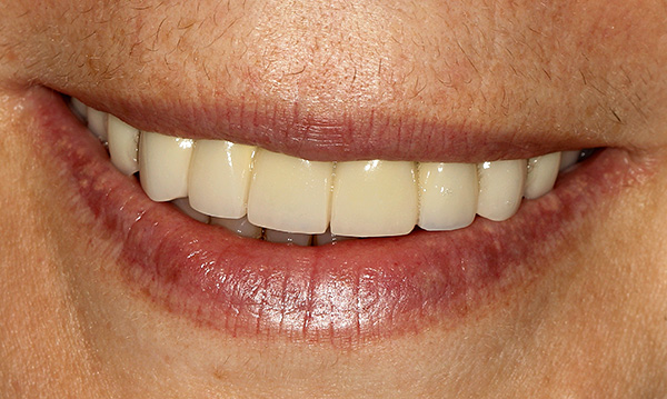 As próteses removíveis de alta qualidade restauram a função mastigatória e a beleza de um sorriso.