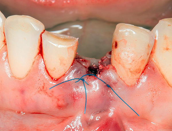 Dentaduras imediatas são usadas para restaurar a estética quase imediatamente após a extração do dente.