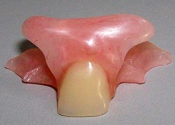 Prótese dentária imediata