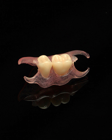 Prótese borboleta de dois dentes.