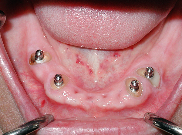 Implantes intracanal para fixação da prótese.