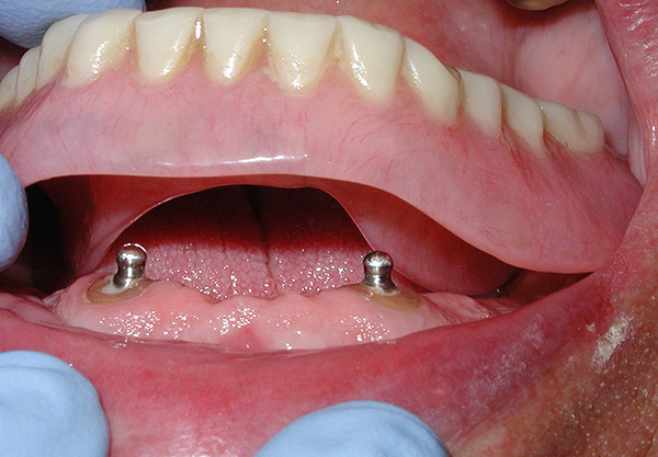 Graças aos implantes intra-canais, a prótese é fixada com muita segurança e uma alta estética pode ser alcançada.