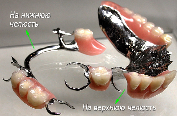 Aperte as dentaduras na mandíbula superior e inferior com fixação nos grampos.