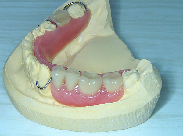 Infelizmente, ganchos de metal, caindo na zona do sorriso, estragam bastante a estética das próteses.