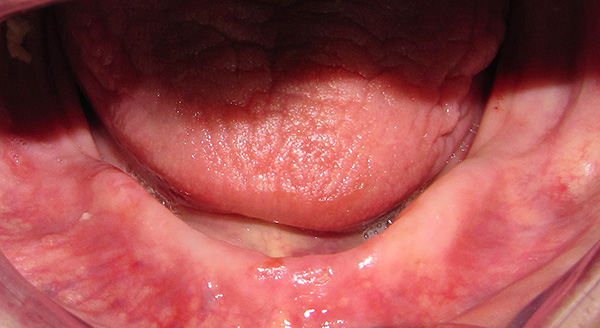 E aqui está o maxilar inferior sem dentes.