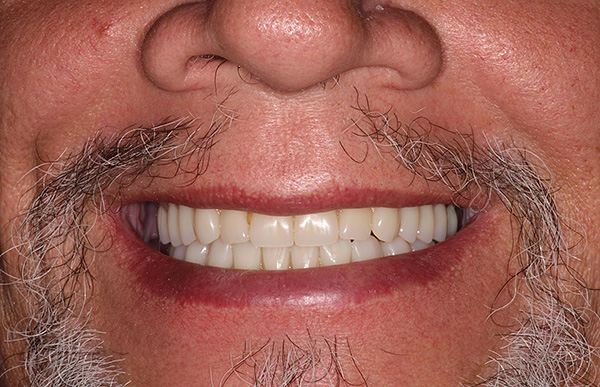 Quando o conforto e a estética máximos são necessários e o preço não é crítico, faz sentido usar próteses removíveis condicionalmente com fixação nos implantes.