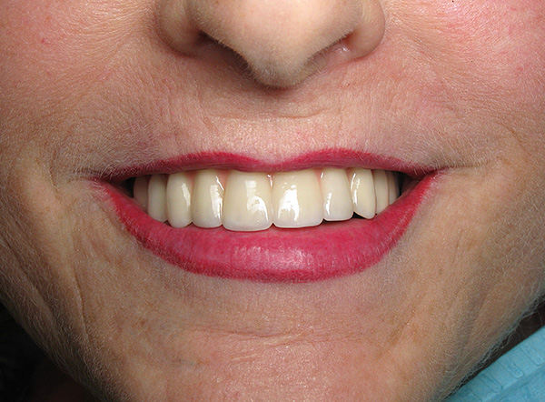 A foto mostra o resultado de próteses usando próteses removíveis condicionalmente em implantes.