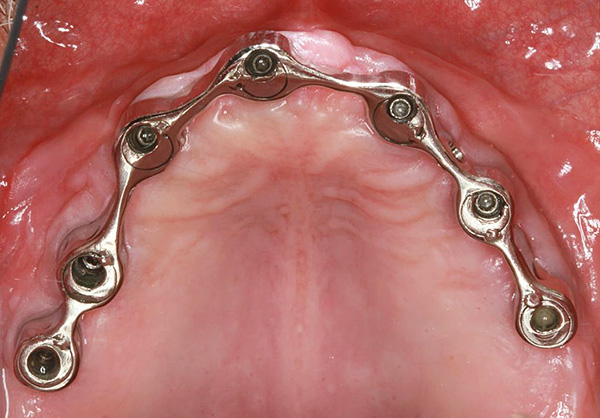 Uma viga de metal combina os implantes instalados em um único todo.