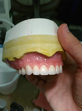 Prótese total removível em gesso.