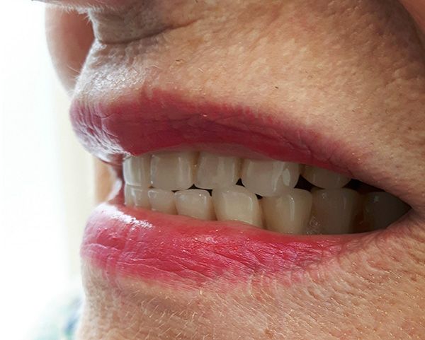 Com um trabalho bem feito, a pessoa recebe não apenas um sorriso bonito, mas também a oportunidade de mastigar alimentos confortavelmente.
