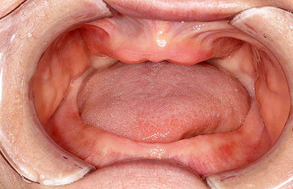 Mesmo quando todos os dentes estão ausentes na cavidade bucal, a membrana mucosa e outras nuances anatômicas tornam cada situação especial, e isso deve ser levado em consideração individualmente para cada paciente.