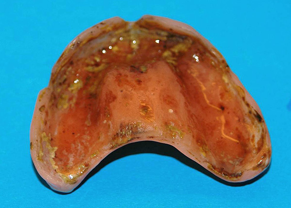 Tal viveiro de microorganismos pode piorar significativamente a saúde geral da cavidade oral.