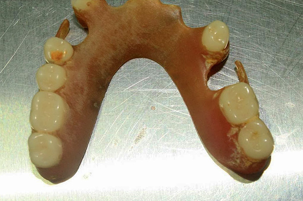 A placa bacteriana se forma em qualquer dentadura, por isso é importante limpá-la regularmente.