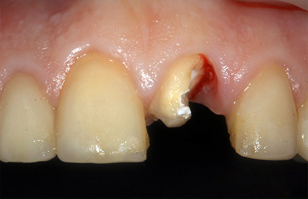 Caso clínico: o dente da frente está quebrado devido a lesão mecânica.