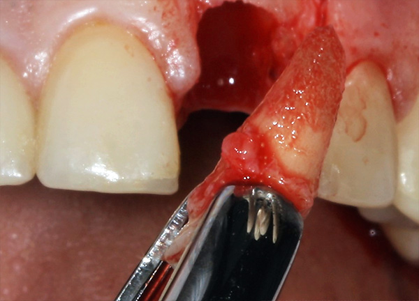 Para realizar o implante imediato, a raiz do dente deve ser removida com a maior precisão possível, sem danificar as paredes ósseas do orifício.