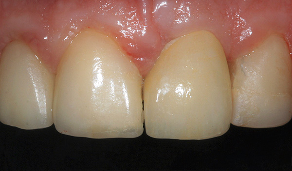 Uma coroa de cerâmica é instalada no pilar - na aparência é quase indistinguível do dente nativo.