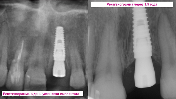 Controle de raios-X - imagens imediatamente após a colocação do implante e após 1,5 anos.