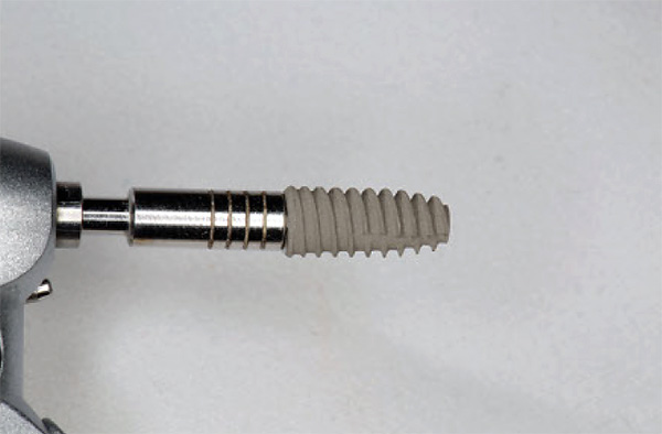 Os implantes dentários são produtos de alta tecnologia, resultado de inúmeros estudos e experiências.