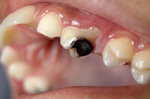 O custo do tratamento de um dente destruído por cárie é imediatamente afetado por muitos fatores, que continuaremos a considerar ...