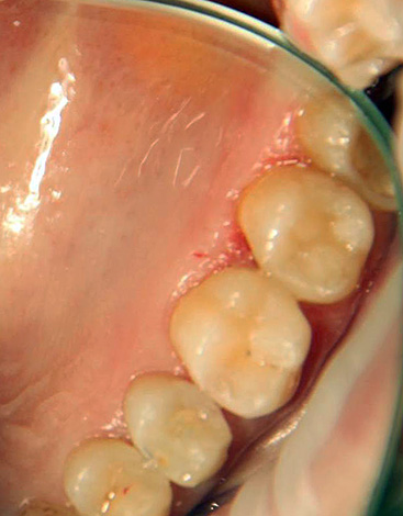 Uma pessoa não treinada está longe de ser sempre capaz de descobrir de forma independente qual dente precisa de tratamento - um médico que não está limpo à mão pode tirar vantagem disso.