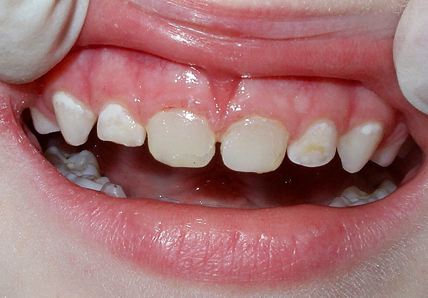 Um exemplo de cárie inicial nos dentes de um bebê.