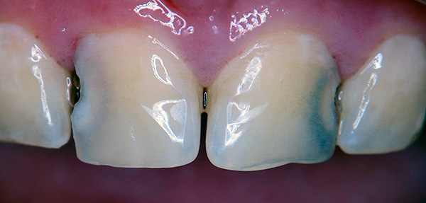 Muitas vezes, é entre os dentes que a comida não é completamente limpa - aqui começa o desenvolvimento da cárie.