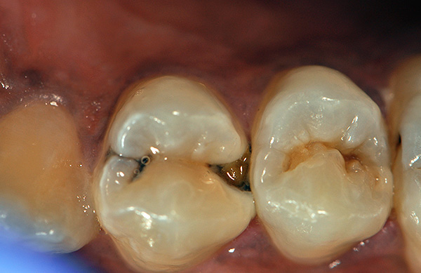 O custo de uma vedação instalada em um dente após a sua preparação pode variar significativamente.