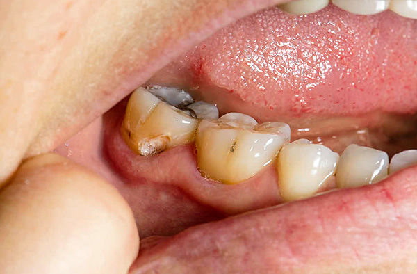 Se o dente não for tratado a tempo, o processo de cárie na zona cervical só progredirá.