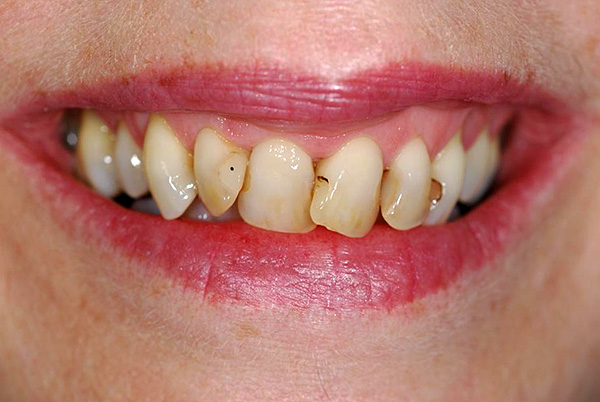 O custo do tratamento dos dentes anteriores, via de regra, é notavelmente mais alto, pois há um aumento nos requisitos de estética.