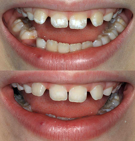 Usando a tecnologia ICON, é possível se livrar de defeitos de esmalte cariados sem usar uma broca.