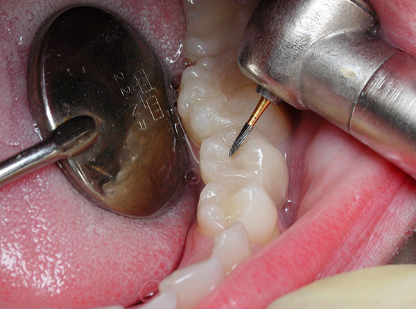 A broca ainda é uma das principais ferramentas no arsenal de um dentista.