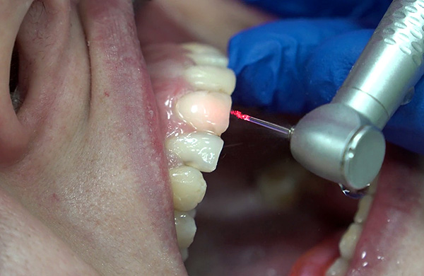A fotografia mostra a preparação do dente da frente com um laser dental.