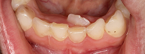 Dente superficial em uma criança