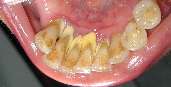 A foto mostra um exemplo típico da condição dos dentes com um nível insatisfatório de higiene bucal.