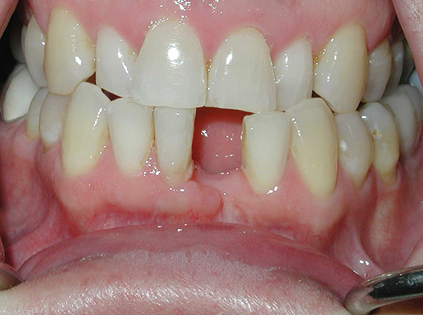 A situação antes do tratamento - não há dente da frente a partir do fundo.
