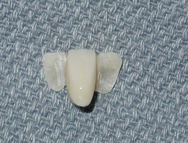 A prótese possui placas especiais no lado que serão coladas aos dentes do pilar.