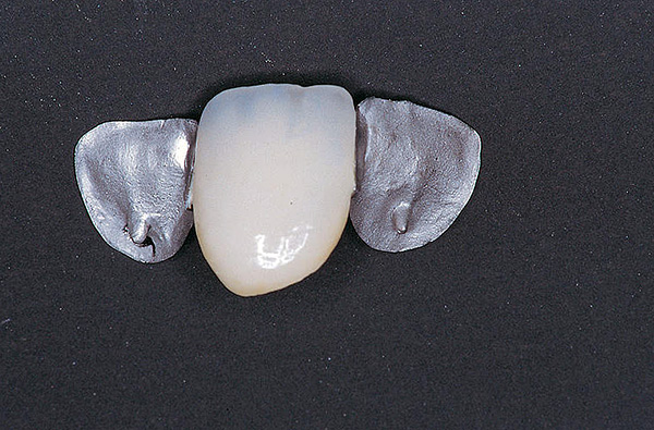 Deve-se ter em mente que é recomendável aplicar esse projeto apenas para eliminar temporariamente o defeito da dentição.
