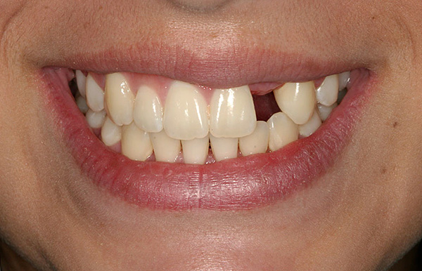 A perda de um único dente sem próteses oportunas pode afetar muito negativamente a condição de toda a dentição.