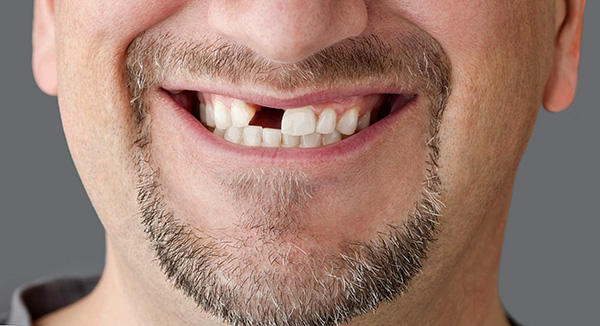 Os preços das próteses dentárias podem variar bastante, às vezes várias vezes, determinados por vários fatores ...