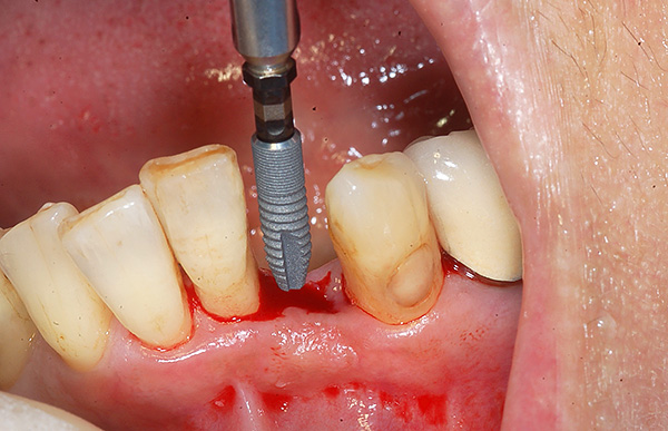 A opção mais preferida são as próteses de implantes.