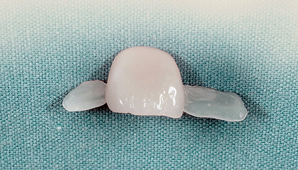 E parece uma ponte adesiva do dente da frente (incisivo superior).
