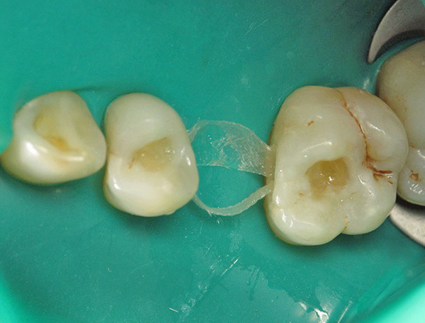 Entre os dentes, estende-se a base de fibra de vidro da futura prótese.