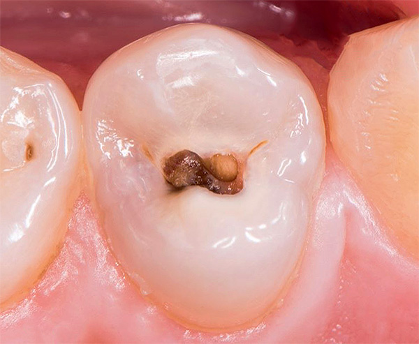 Com cárie moderada, o processo de destruição afeta não apenas o esmalte dos dentes, mas também a dentina sob ele ...